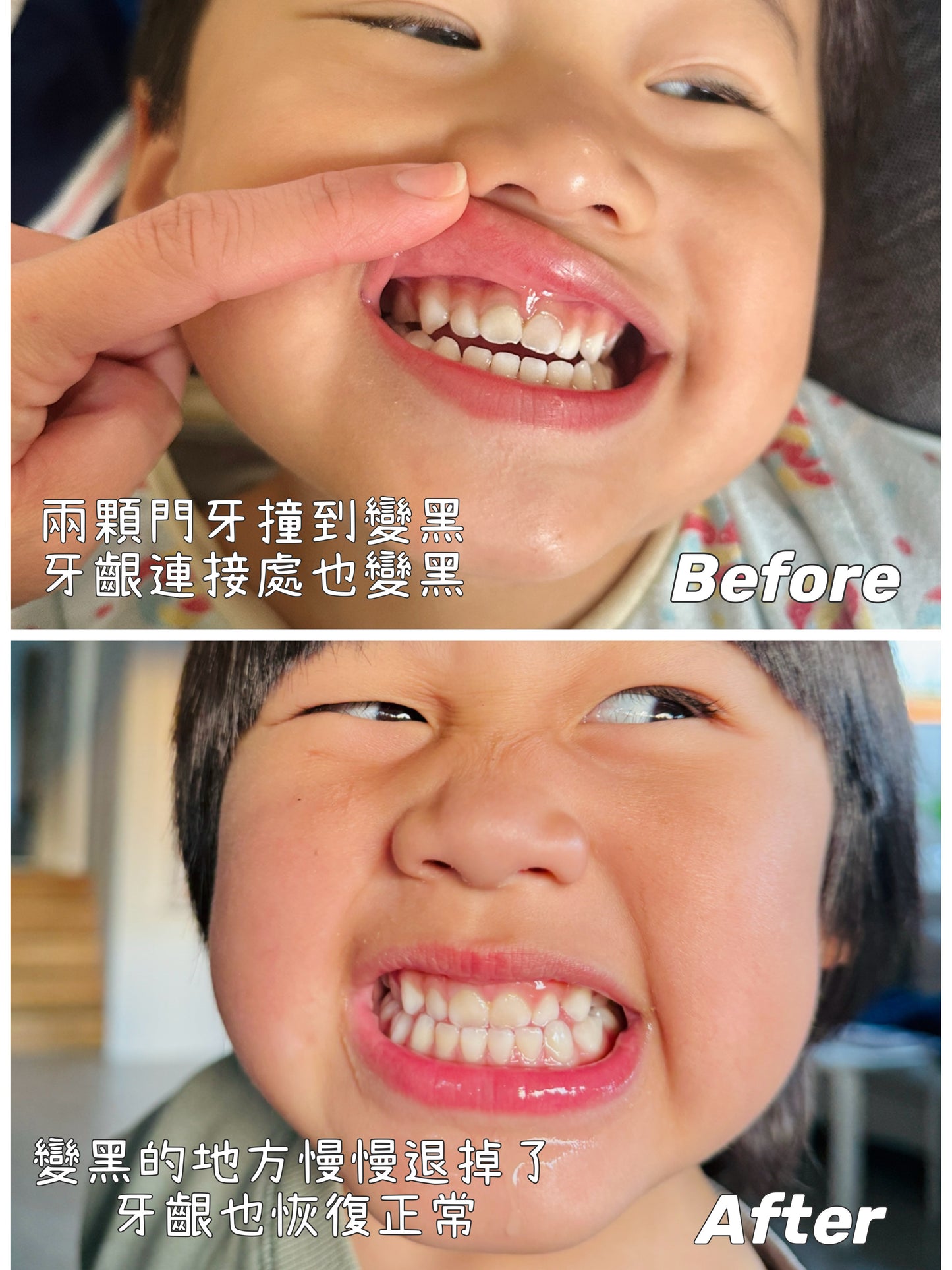 GC Tooth Mousse牙齒修復慕斯
